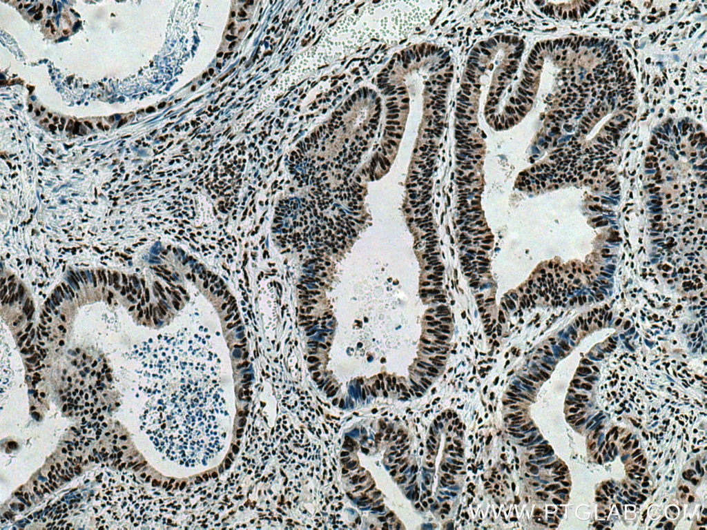 Immunohistochemistry (IHC) staining of human colon cancer tissue using EIF4A3 Monoclonal antibody (67740-1-Ig)