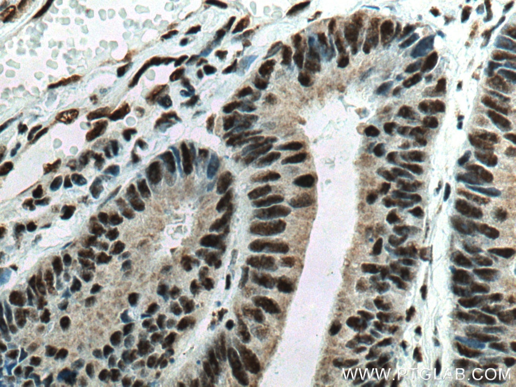 Immunohistochemistry (IHC) staining of human colon cancer tissue using EIF4A3 Monoclonal antibody (67740-1-Ig)