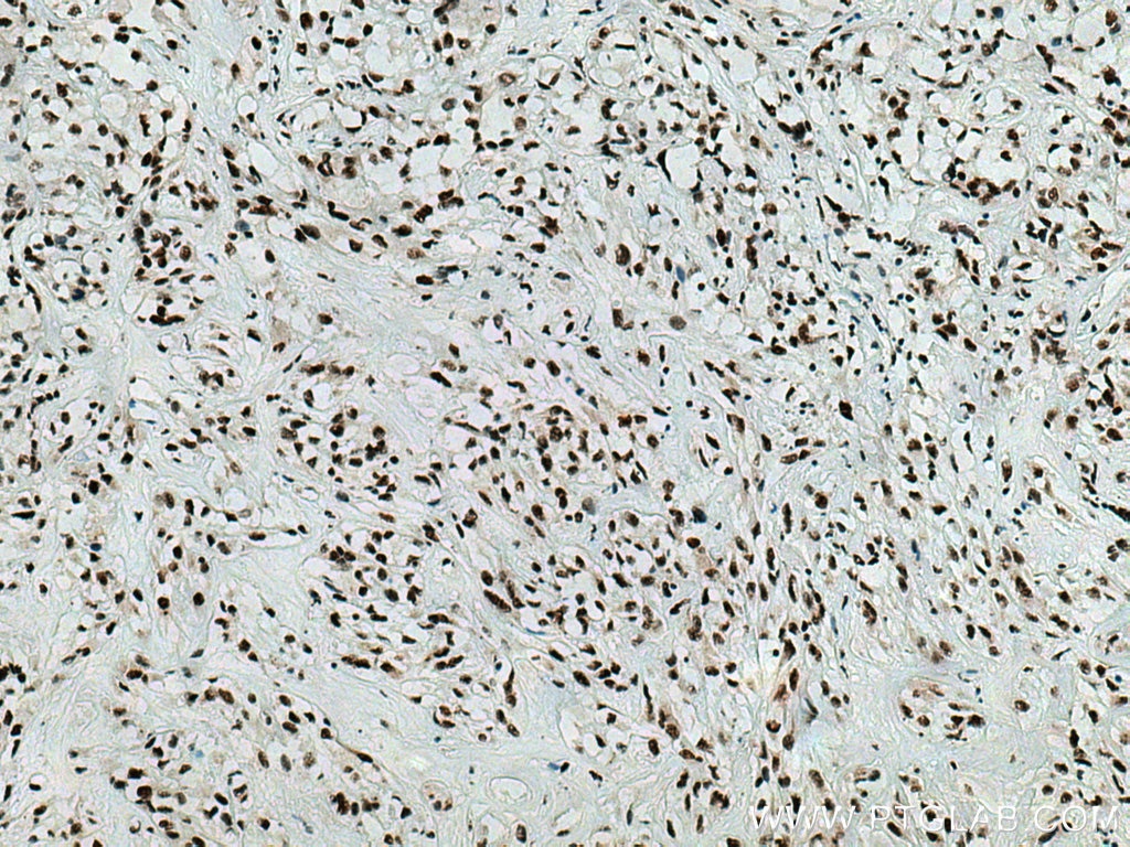 Immunohistochemistry (IHC) staining of human renal cell carcinoma tissue using EIF4A3 Monoclonal antibody (67740-1-Ig)