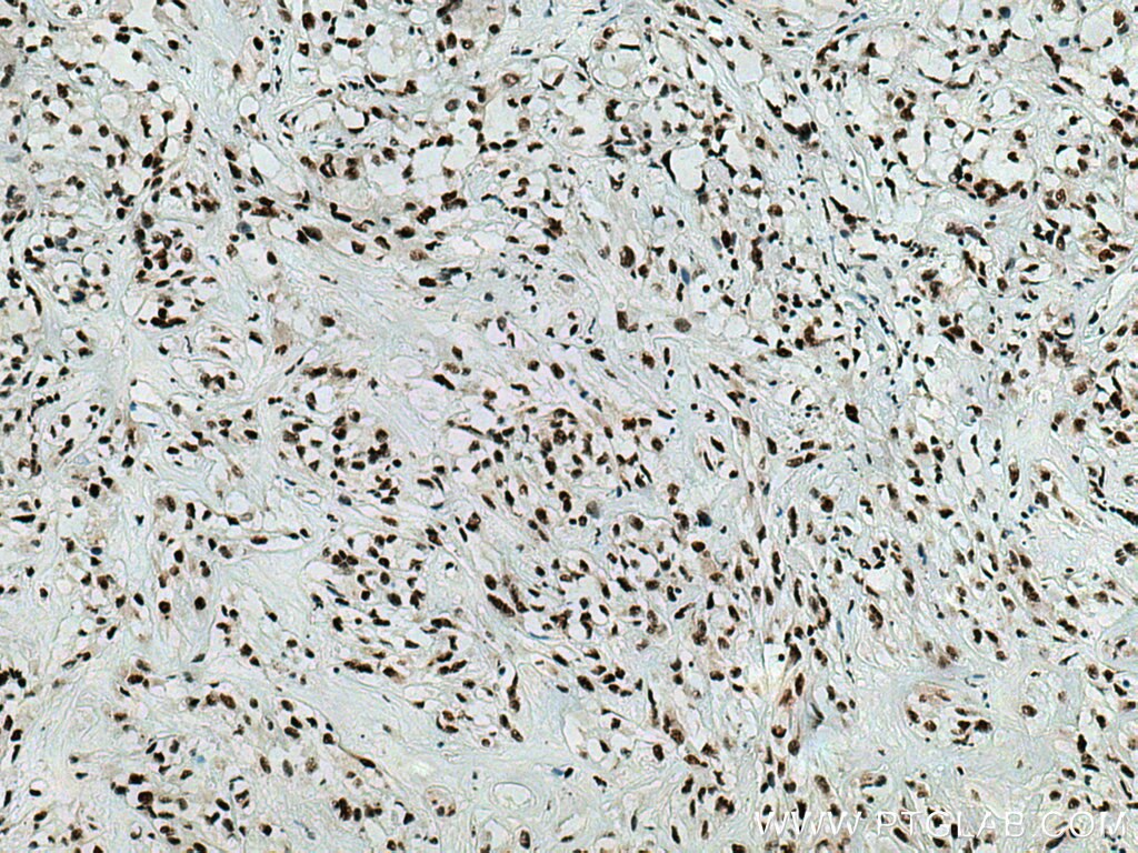 Immunohistochemistry (IHC) staining of human renal cell carcinoma tissue using EIF4A3 Monoclonal antibody (67740-1-Ig)