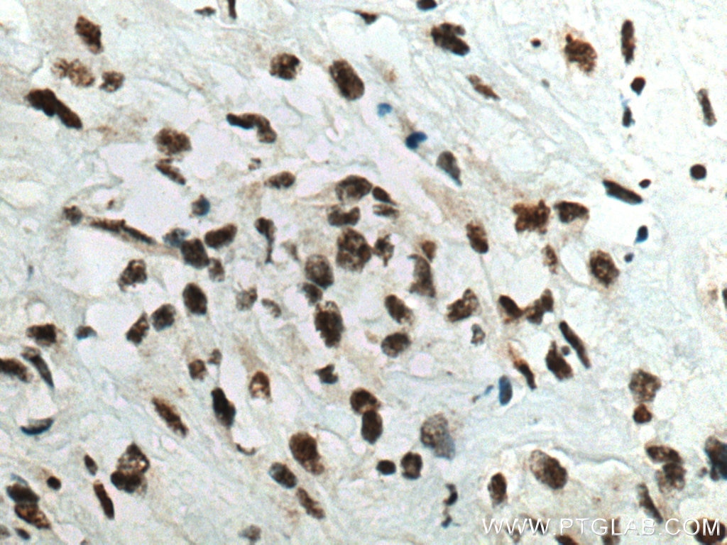 IHC staining of human renal cell carcinoma using 67740-1-Ig