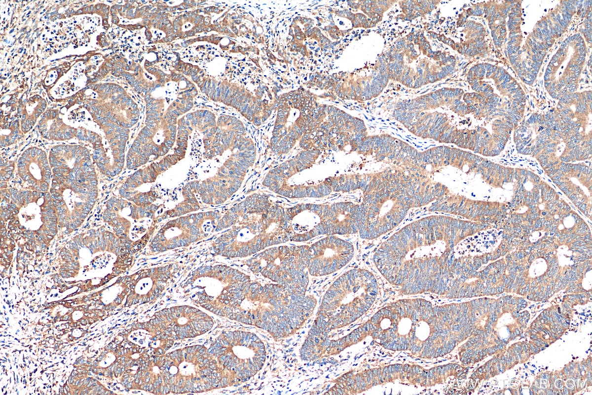 Immunohistochemistry (IHC) staining of human colon cancer tissue using EIF4E Polyclonal antibody (29712-1-AP)