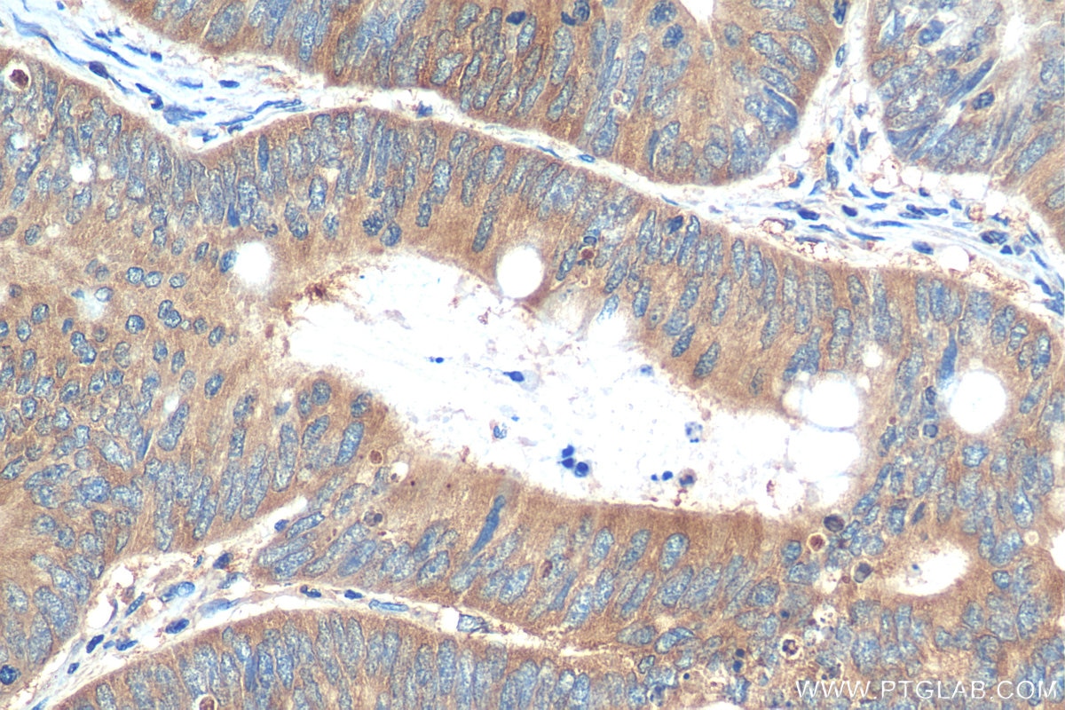 Immunohistochemistry (IHC) staining of human colon cancer tissue using EIF4E Polyclonal antibody (29712-1-AP)