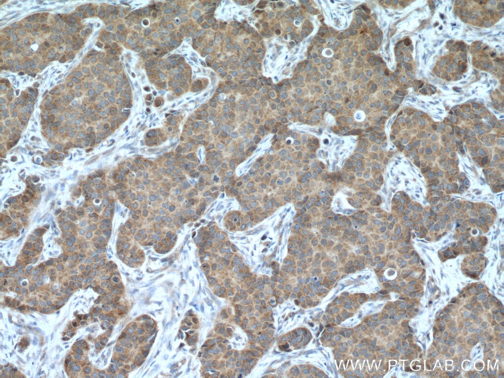 Immunohistochemistry (IHC) staining of human breast cancer tissue using EIF4E Monoclonal antibody (66655-1-Ig)