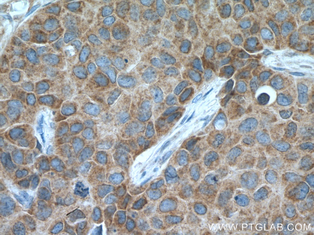 Immunohistochemistry (IHC) staining of human breast cancer tissue using EIF4E Monoclonal antibody (66655-1-Ig)