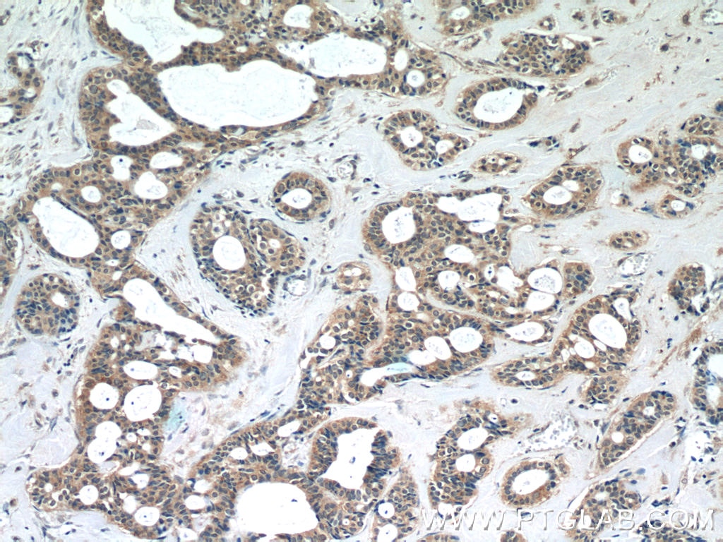 Immunohistochemistry (IHC) staining of human breast cancer tissue using EIF4E2 Polyclonal antibody (12227-1-AP)