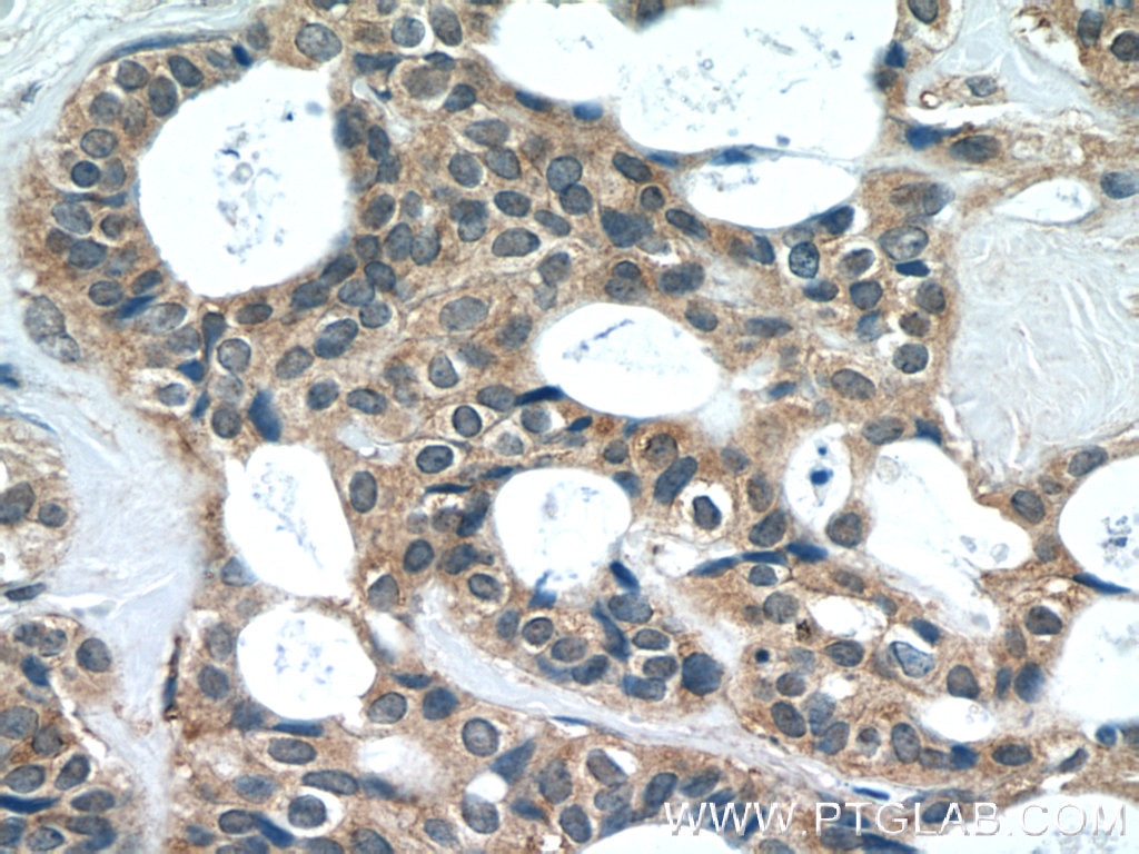 Immunohistochemistry (IHC) staining of human breast cancer tissue using EIF4E2 Polyclonal antibody (12227-1-AP)