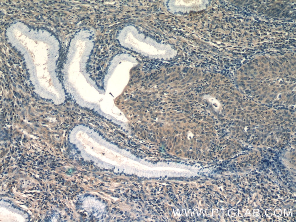 IHC staining of human cervical cancer using 12227-1-AP