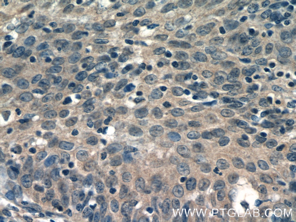 Immunohistochemistry (IHC) staining of human cervical cancer tissue using EIF4E2 Polyclonal antibody (12227-1-AP)