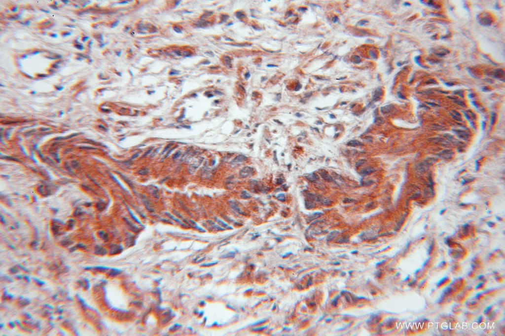 Immunohistochemistry (IHC) staining of human prostate cancer tissue using EIF4EBP2 Polyclonal antibody (11182-1-AP)