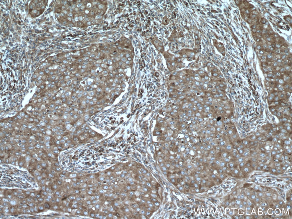Immunohistochemistry (IHC) staining of human breast cancer tissue using EIF4G1 Polyclonal antibody (15704-1-AP)