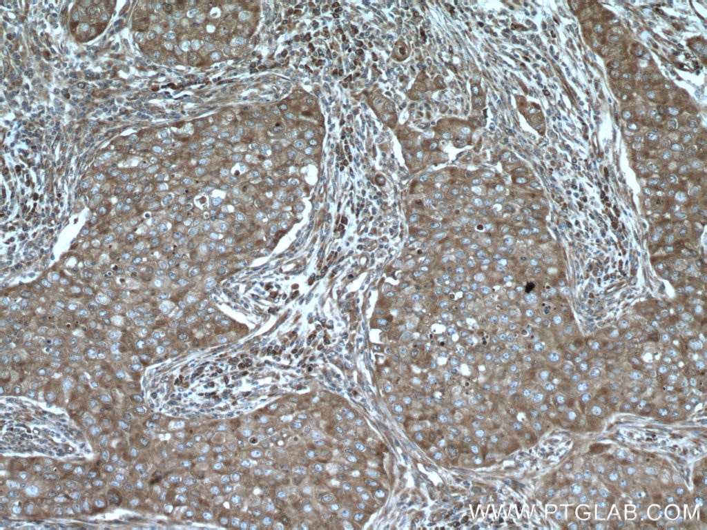 IHC staining of human breast cancer using 15704-1-AP