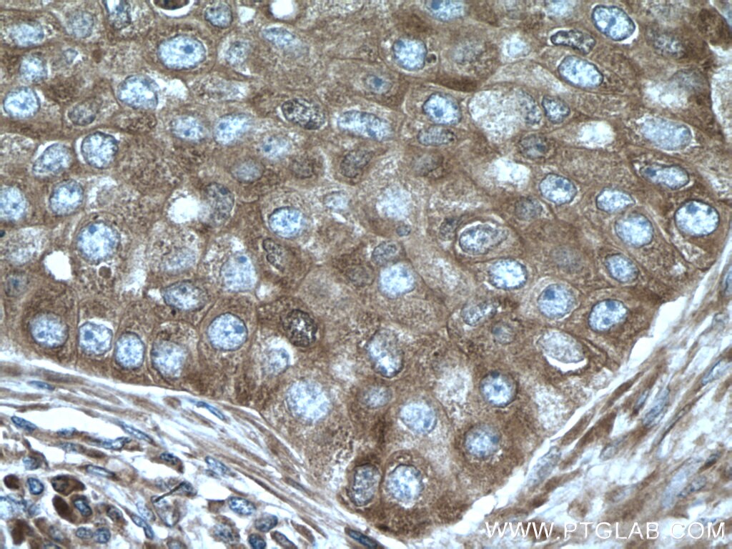 Immunohistochemistry (IHC) staining of human breast cancer tissue using EIF4G1 Polyclonal antibody (15704-1-AP)