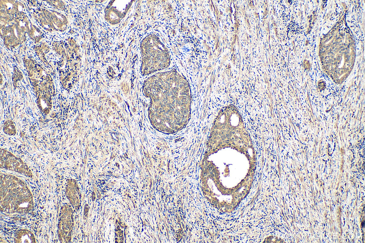 Immunohistochemistry (IHC) staining of human prostate cancer tissue using eIF4G2/DAP5 Polyclonal antibody (17728-1-AP)