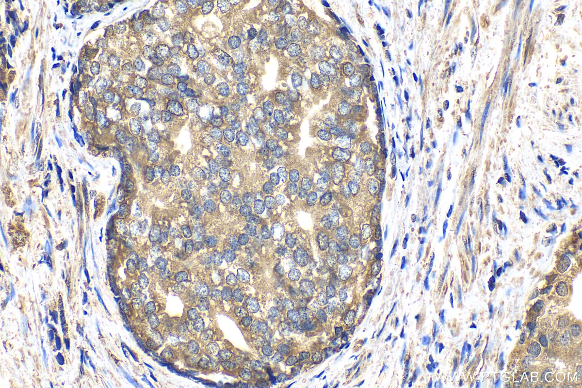 Immunohistochemistry (IHC) staining of human prostate cancer tissue using eIF4G2/DAP5 Polyclonal antibody (17728-1-AP)