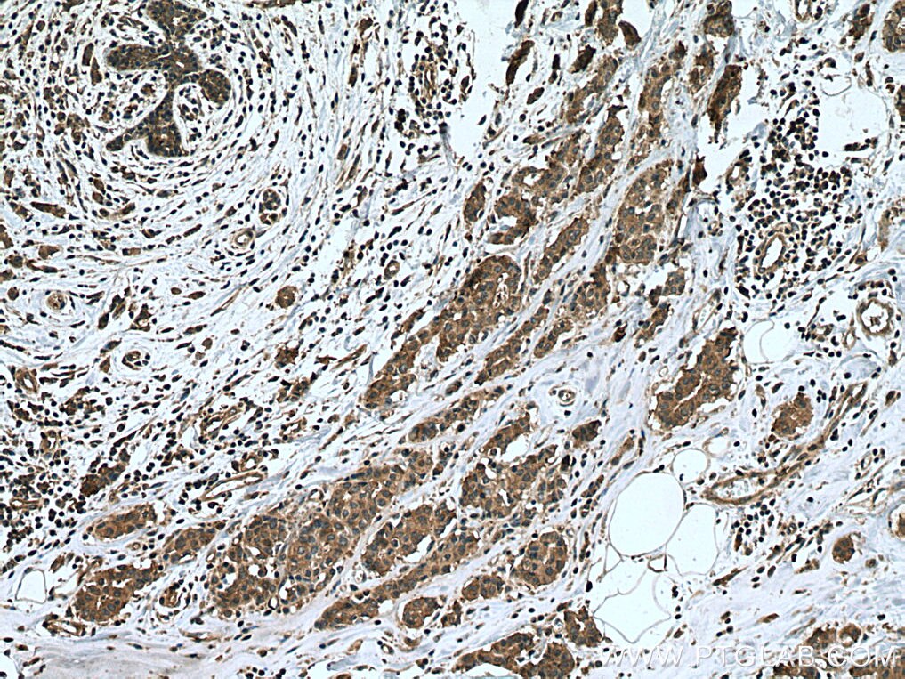 Immunohistochemistry (IHC) staining of human breast cancer tissue using eIF4G2/DAP5 Monoclonal antibody (67428-1-Ig)