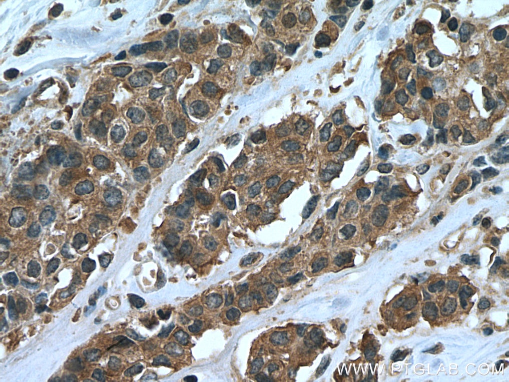 Immunohistochemistry (IHC) staining of human breast cancer tissue using eIF4G2/DAP5 Monoclonal antibody (67428-1-Ig)