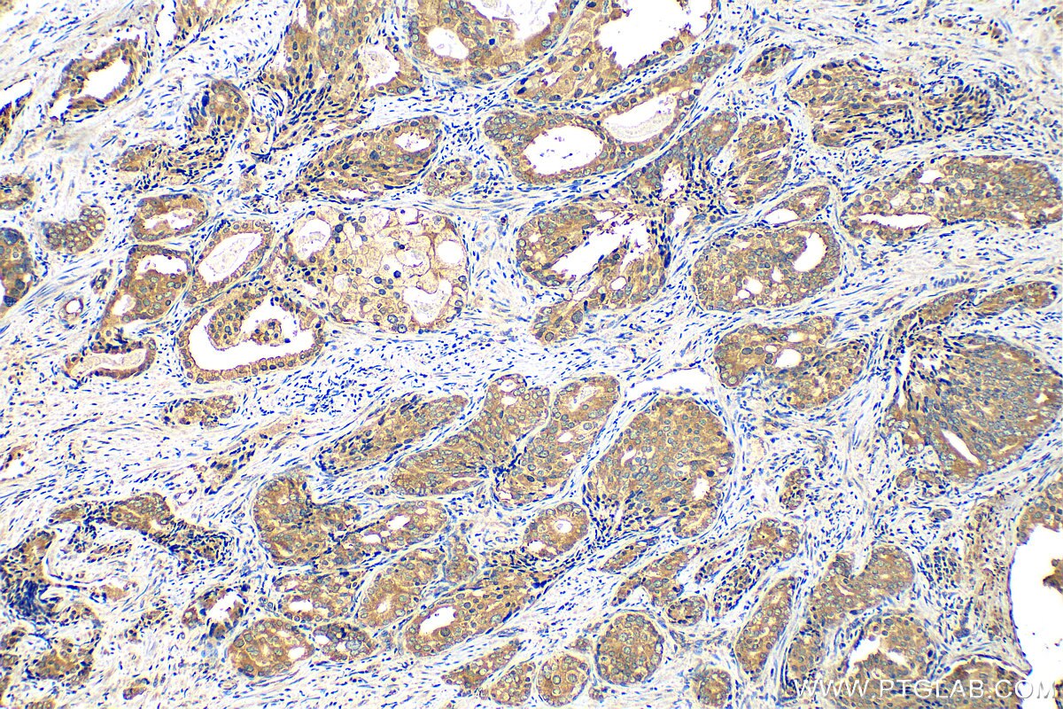 Immunohistochemistry (IHC) staining of human prostate cancer tissue using eIF4G2/DAP5 Monoclonal antibody (67428-1-Ig)