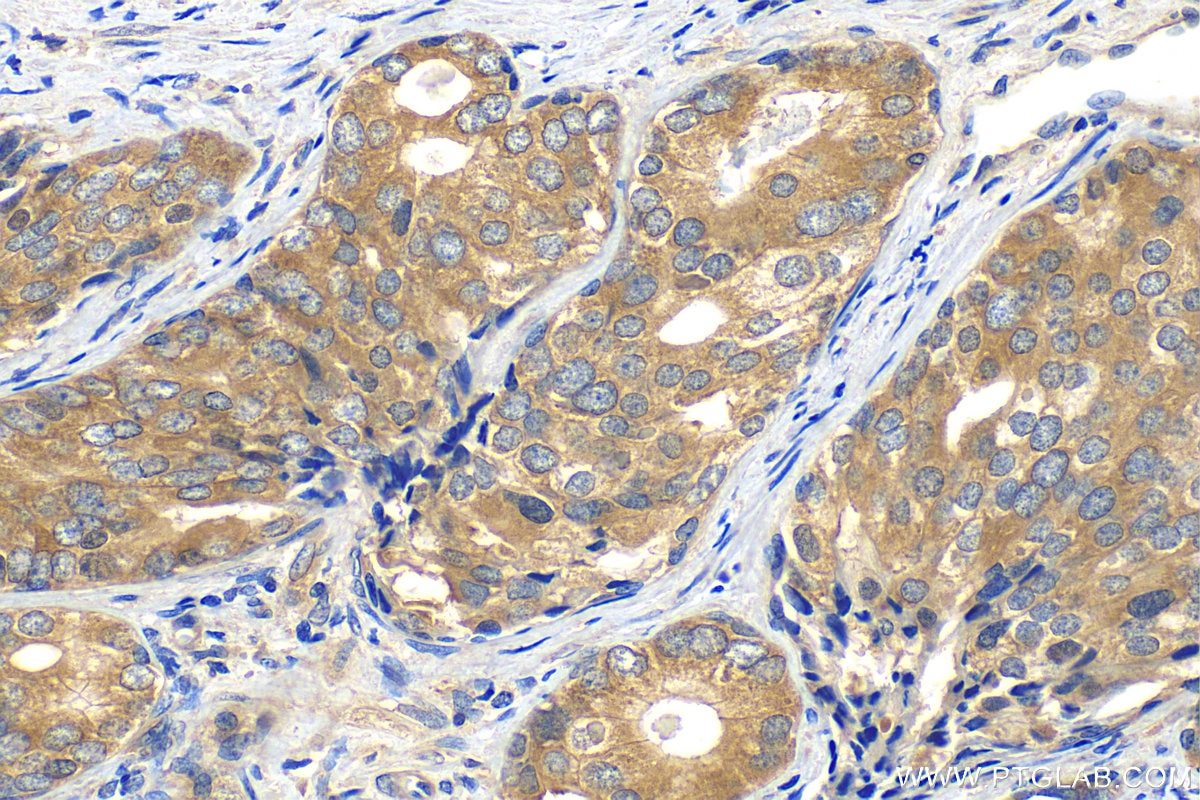 Immunohistochemistry (IHC) staining of human prostate cancer tissue using eIF4G2/DAP5 Monoclonal antibody (67428-1-Ig)