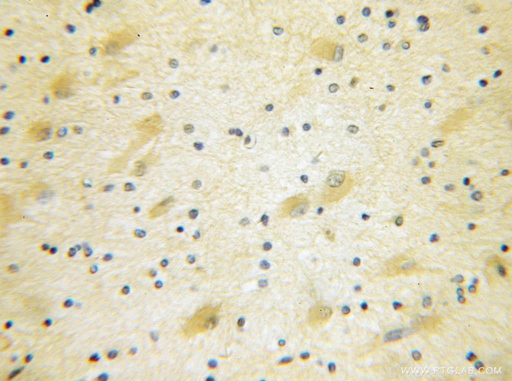 IHC staining of human gliomas using 11281-1-AP