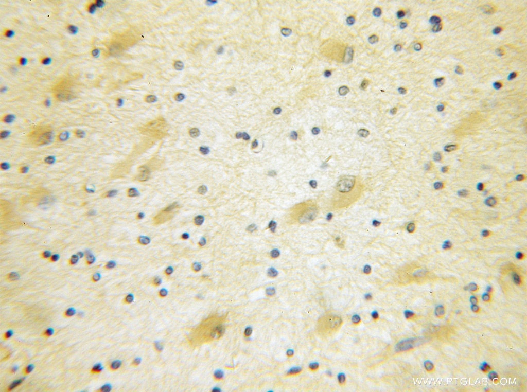 Immunohistochemistry (IHC) staining of human gliomas tissue using EIF4G3 Polyclonal antibody (11281-1-AP)