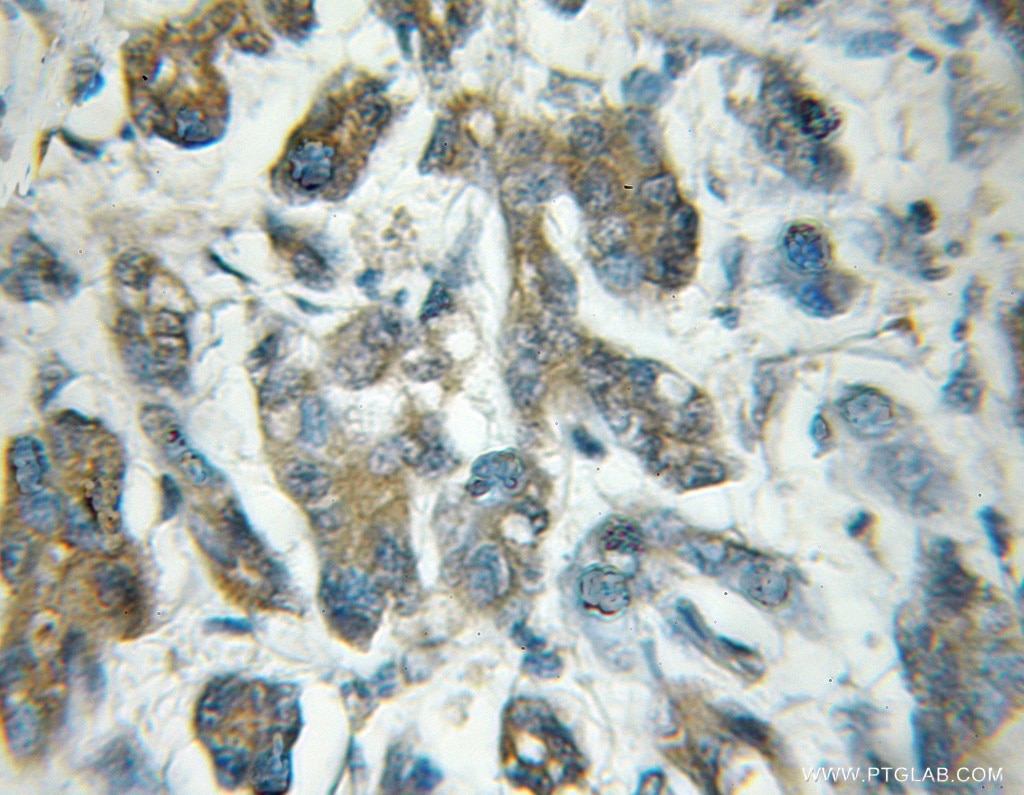 Immunohistochemistry (IHC) staining of human pancreas cancer tissue using EIF5 Polyclonal antibody (11155-1-AP)