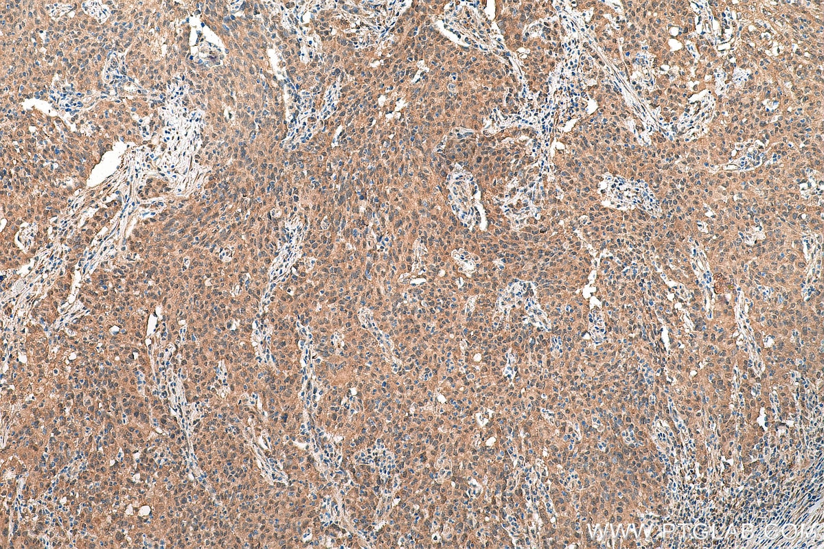 IHC staining of human stomach cancer using 17069-1-AP