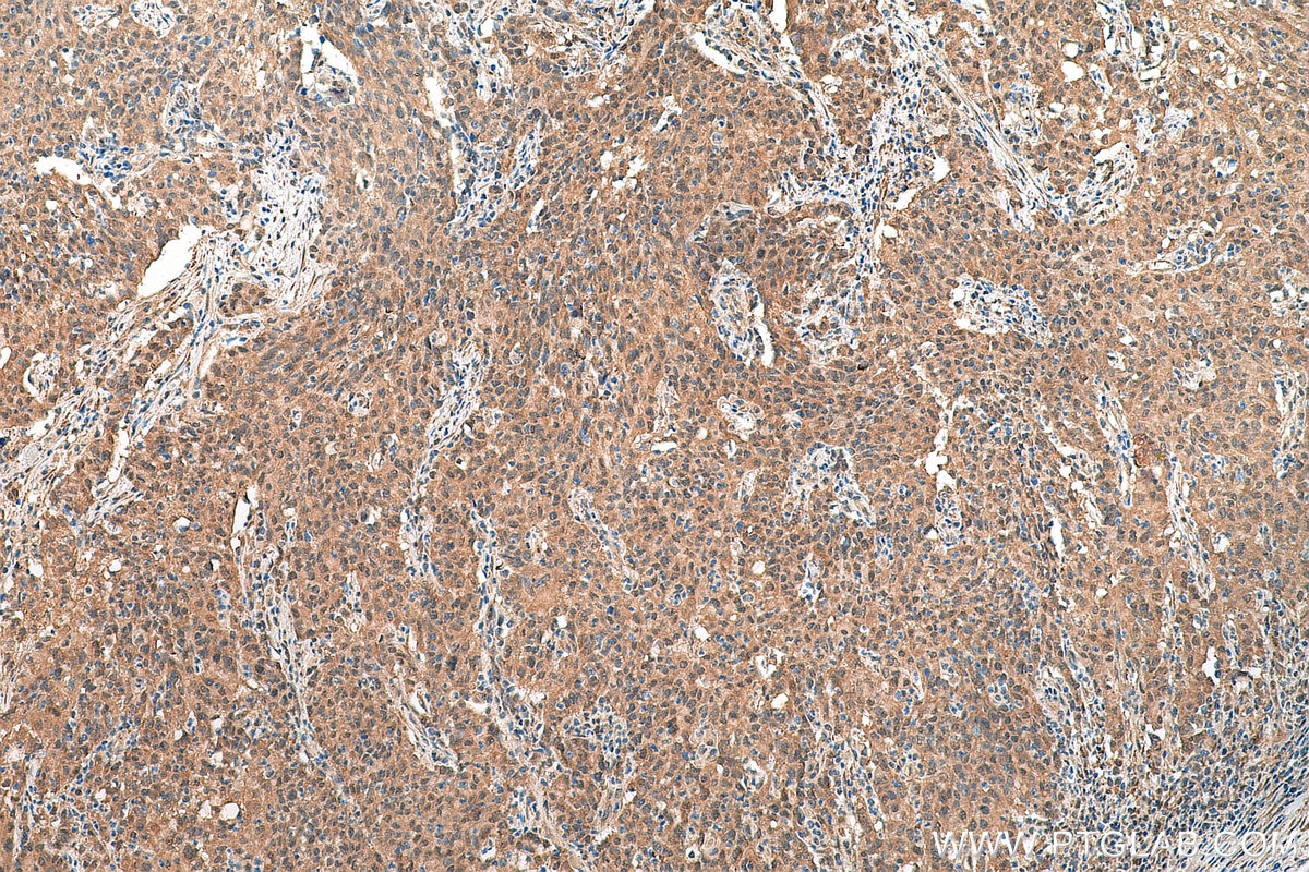 Immunohistochemistry (IHC) staining of human stomach cancer tissue using EIF5A1/EIF5A2 Polyclonal antibody (17069-1-AP)