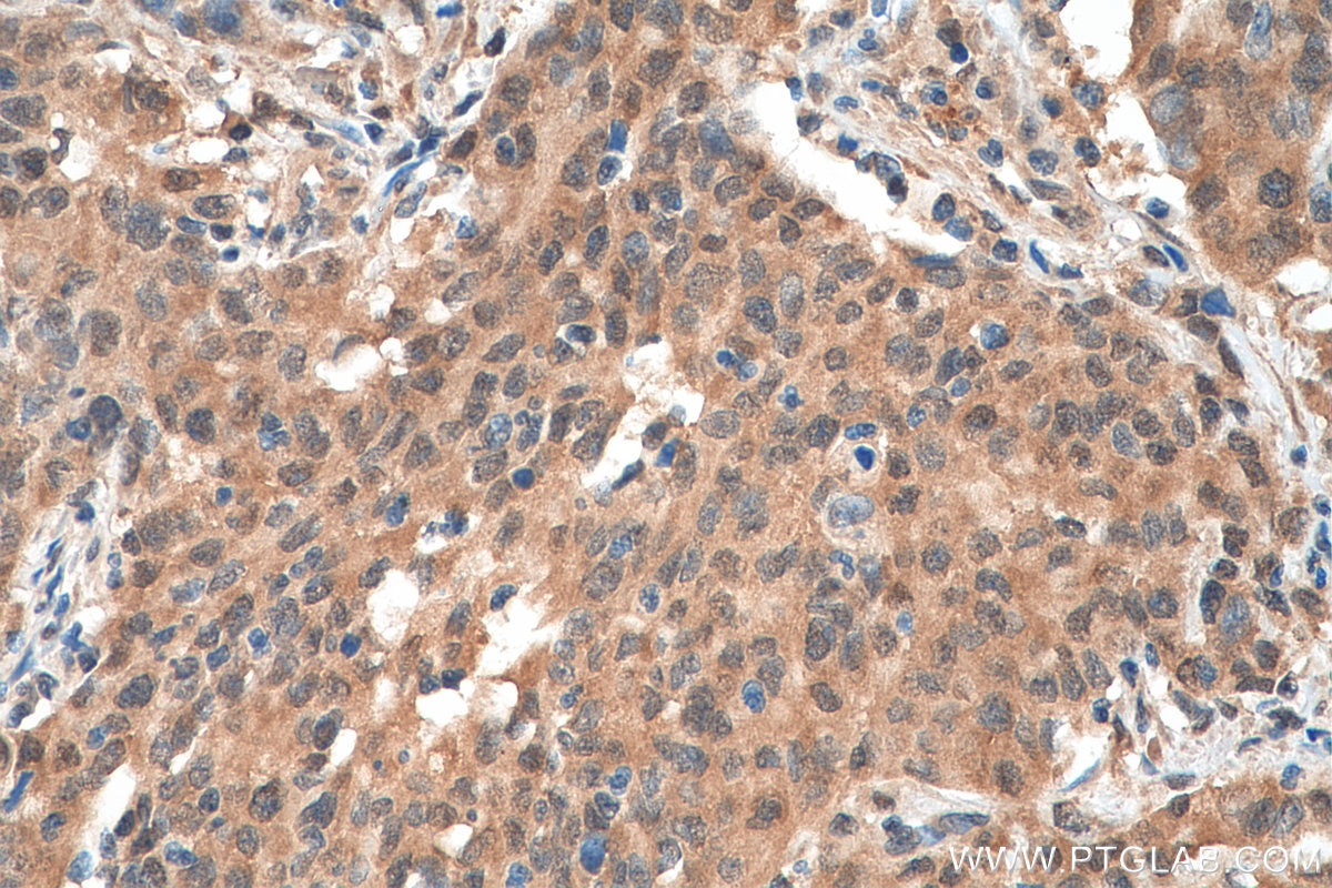 Immunohistochemistry (IHC) staining of human stomach cancer tissue using EIF5A1/EIF5A2 Polyclonal antibody (17069-1-AP)