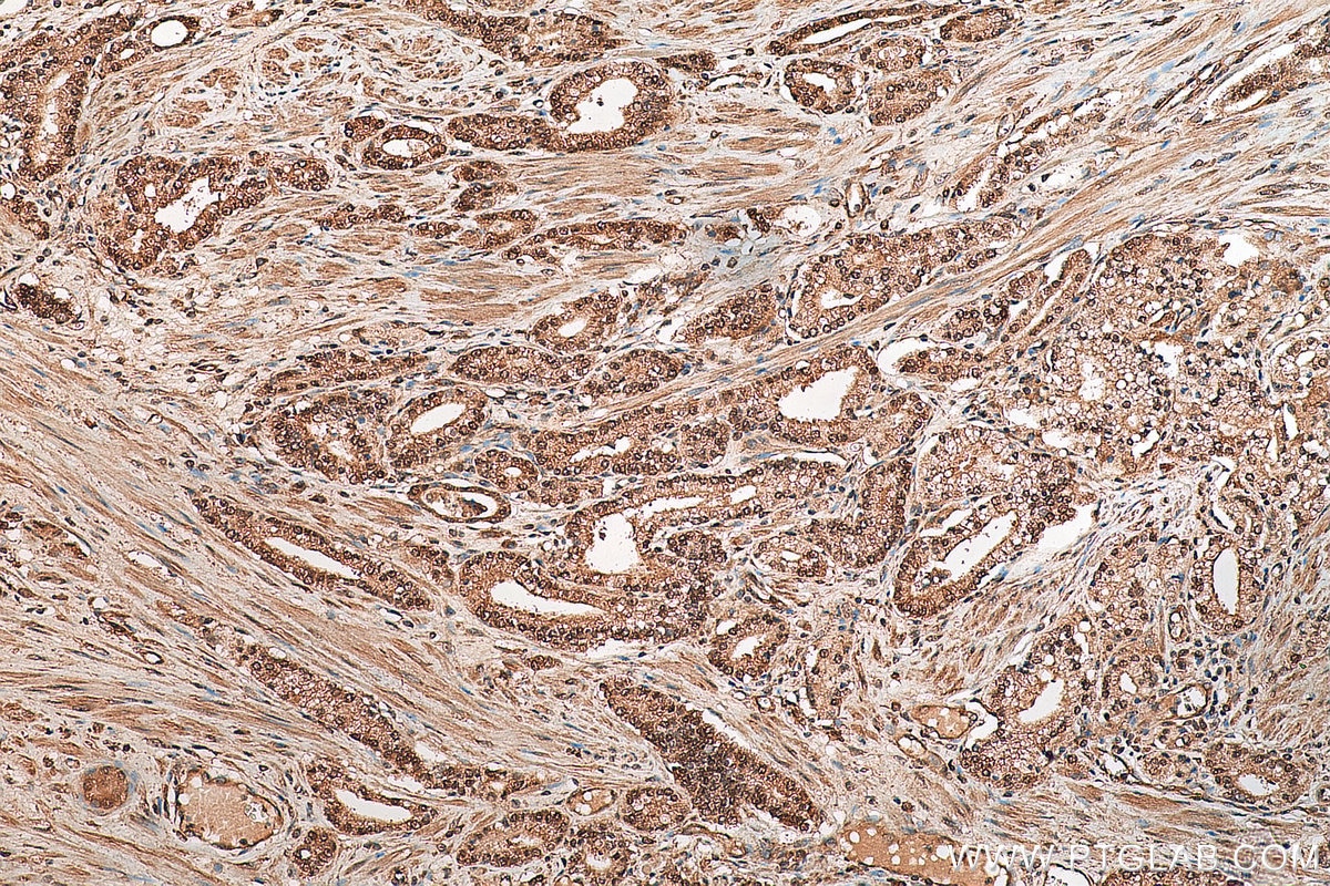 Immunohistochemistry (IHC) staining of human prostate cancer tissue using EIF5A1/EIF5A2 Polyclonal antibody (17069-1-AP)