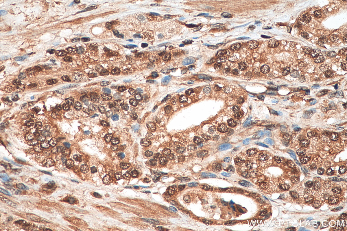 Immunohistochemistry (IHC) staining of human prostate cancer tissue using EIF5A1/EIF5A2 Polyclonal antibody (17069-1-AP)