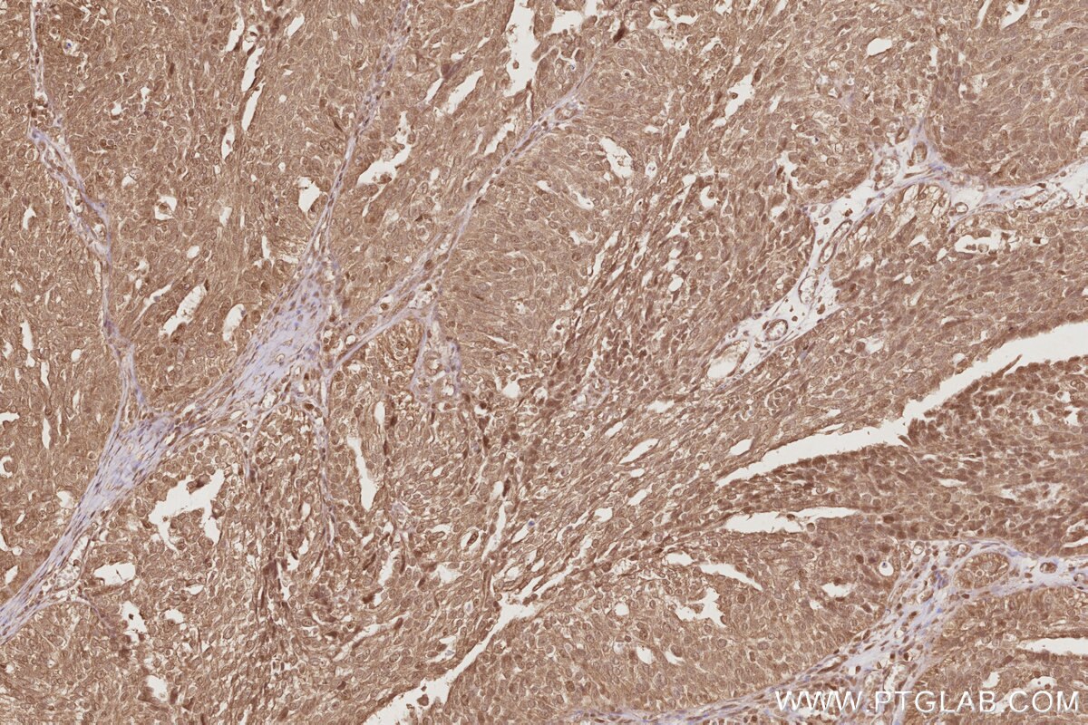 Immunohistochemistry (IHC) staining of human ovary cancer tissue using EIF5A1/EIF5A2 Polyclonal antibody (17069-1-AP)