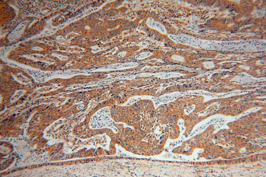 Immunohistochemistry (IHC) staining of human colon cancer tissue using EIF5A1/EIF5A2 Polyclonal antibody (17069-1-AP)