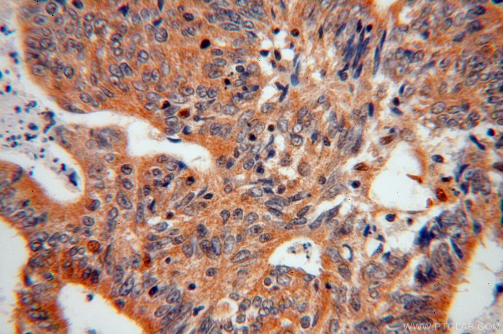 Immunohistochemistry (IHC) staining of human colon cancer tissue using EIF5A1/EIF5A2 Polyclonal antibody (17069-1-AP)