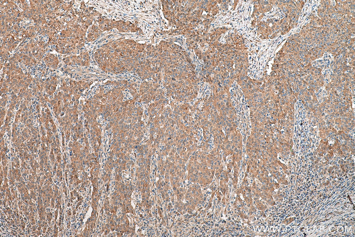 IHC staining of human stomach cancer using 67907-1-Ig