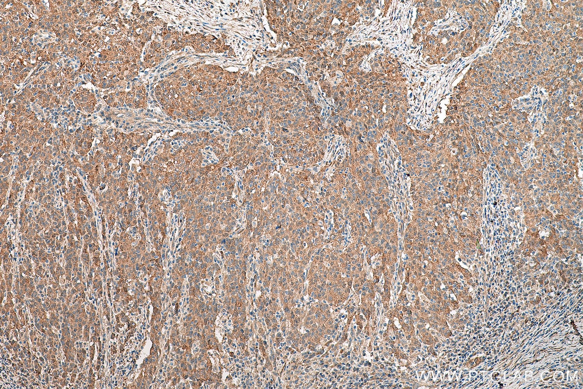 Immunohistochemistry (IHC) staining of human stomach cancer tissue using EIF5A2 Monoclonal antibody (67907-1-Ig)