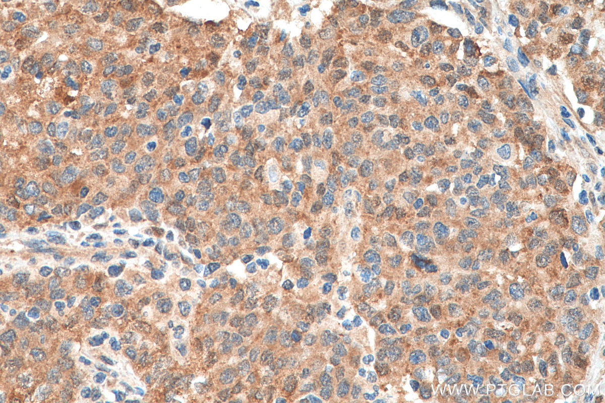 Immunohistochemistry (IHC) staining of human stomach cancer tissue using EIF5A2 Monoclonal antibody (67907-1-Ig)