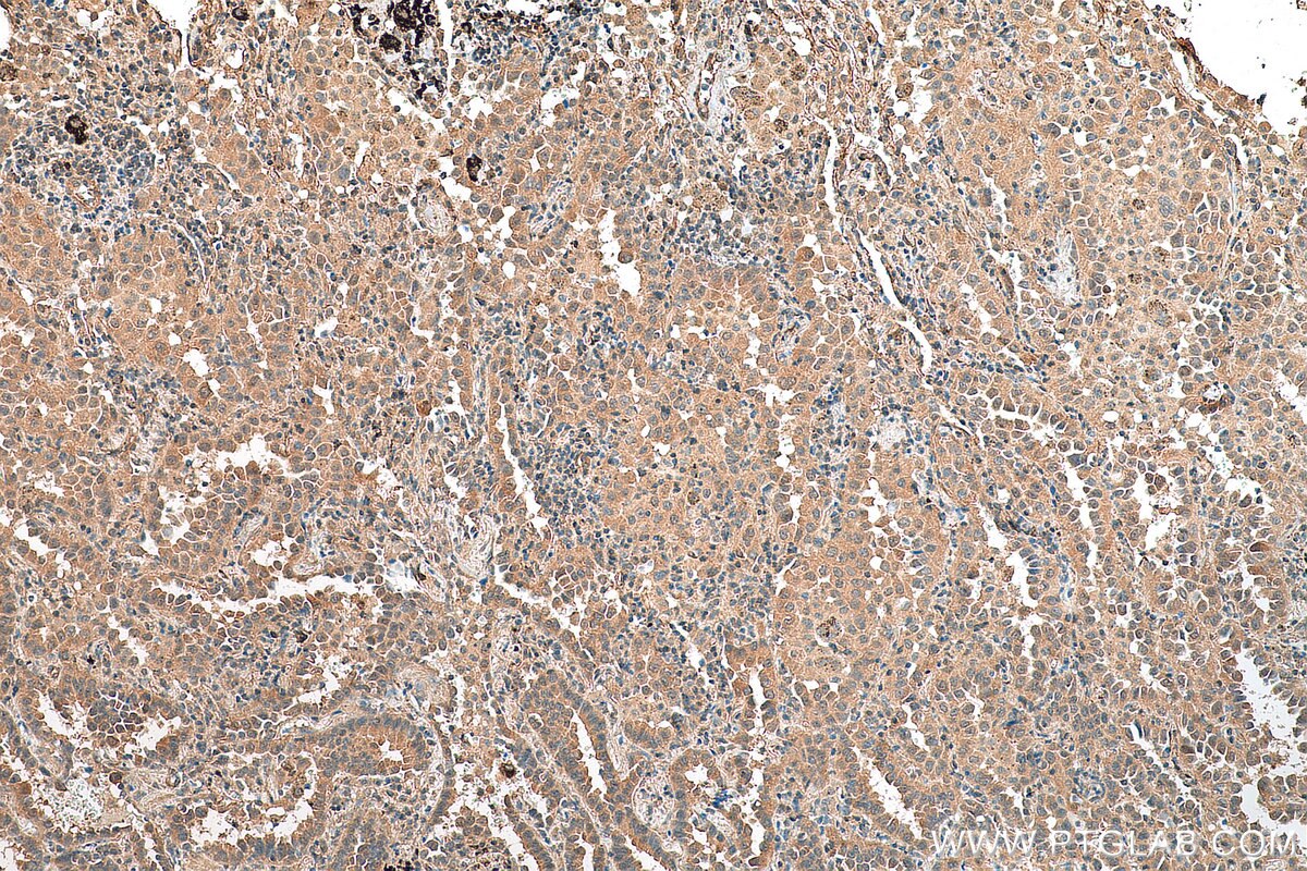 Immunohistochemistry (IHC) staining of human lung cancer tissue using EIF5A2 Monoclonal antibody (67907-1-Ig)