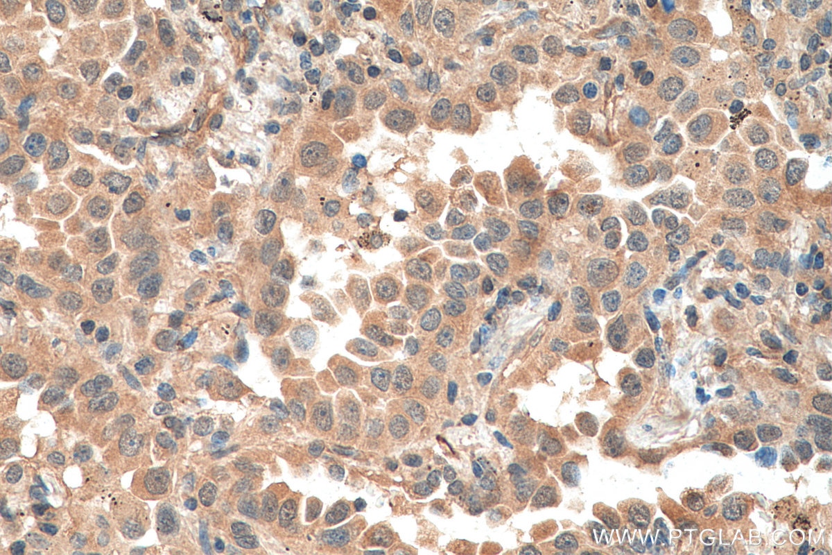 IHC staining of human lung cancer using 67907-1-Ig