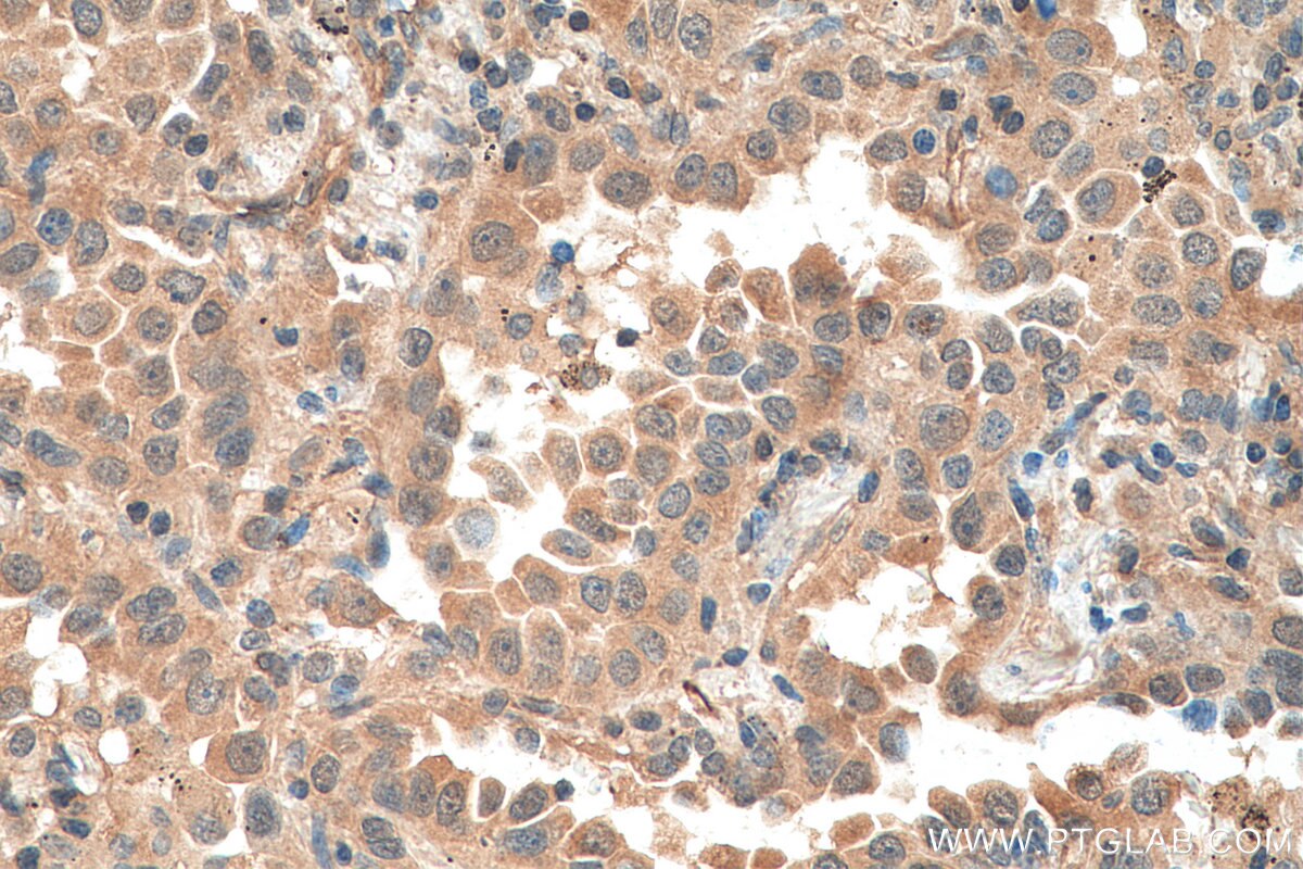 Immunohistochemistry (IHC) staining of human lung cancer tissue using EIF5A2 Monoclonal antibody (67907-1-Ig)