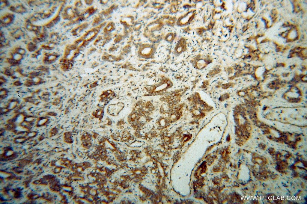Immunohistochemistry (IHC) staining of human gliomas tissue using EIF5B Polyclonal antibody (13527-1-AP)