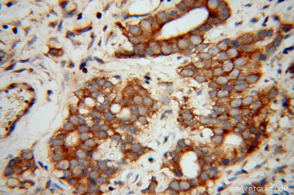 Immunohistochemistry (IHC) staining of human gliomas tissue using EIF5B Polyclonal antibody (13527-1-AP)