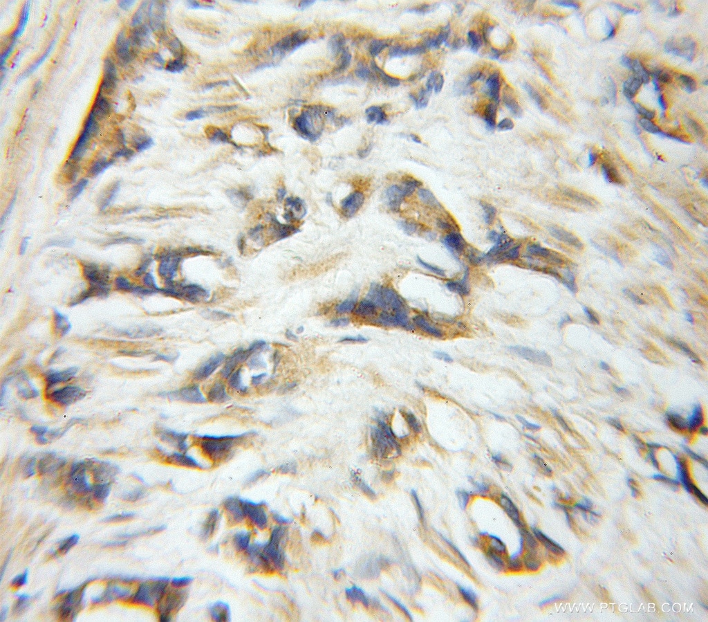 Immunohistochemistry (IHC) staining of human prostate cancer tissue using EIF6 Polyclonal antibody (10291-1-AP)