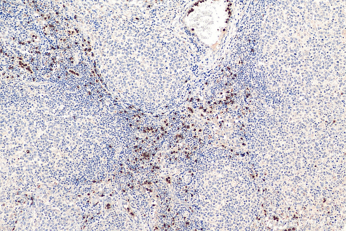 Immunohistochemistry (IHC) staining of human lymphoma tissue using ELA2 Polyclonal antibody (27642-1-AP)