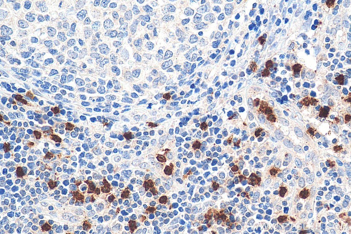 Immunohistochemistry (IHC) staining of human lymphoma tissue using ELA2 Polyclonal antibody (27642-1-AP)