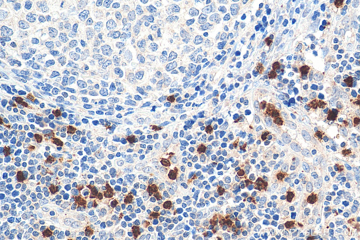 Immunohistochemistry (IHC) staining of human lymphoma tissue using ELA2 Polyclonal antibody (27642-1-AP)