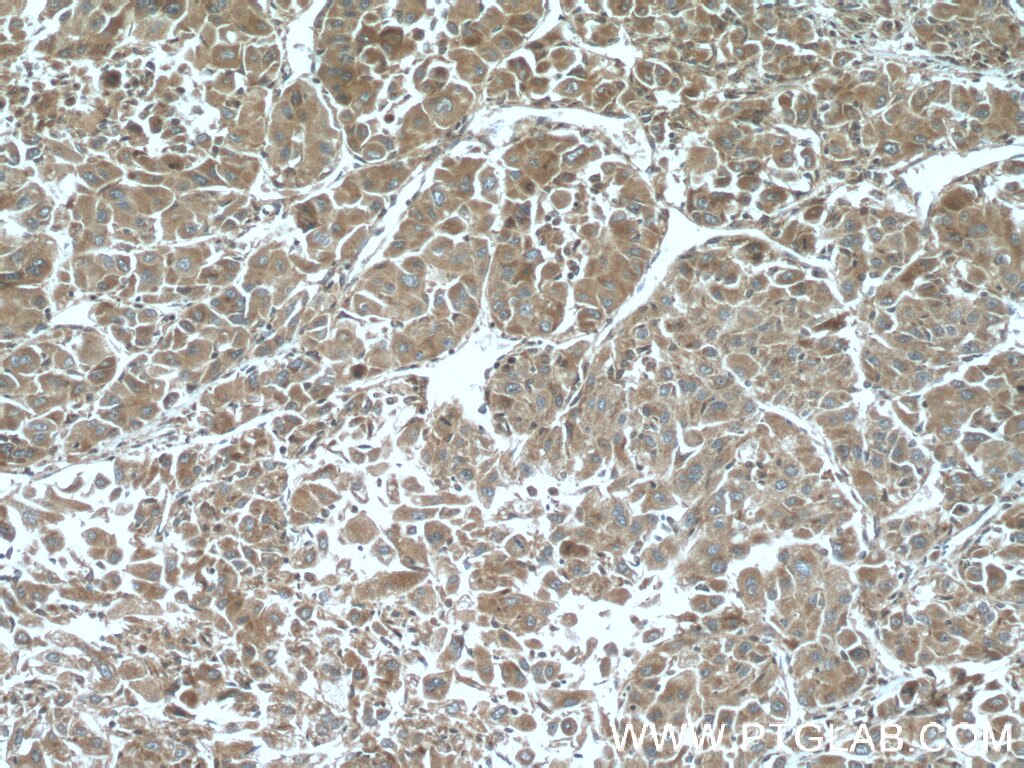 Immunohistochemistry (IHC) staining of human liver cancer tissue using ELAC1 Polyclonal antibody (26639-1-AP)