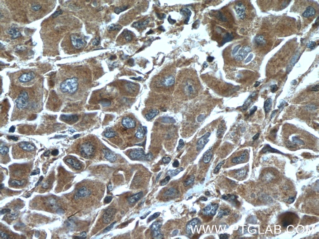 Immunohistochemistry (IHC) staining of human liver cancer tissue using ELAC1 Polyclonal antibody (26639-1-AP)