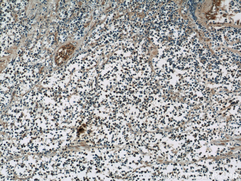 Immunohistochemistry (IHC) staining of human lung cancer tissue using HuC Polyclonal antibody (55047-1-AP)