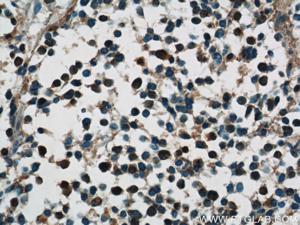 Immunohistochemistry (IHC) staining of human lung cancer tissue using HuC Polyclonal antibody (55047-1-AP)